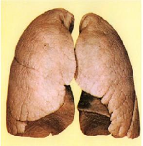 非喫煙者の肺